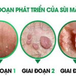 Top 5 địa chỉ phòng khám chữa bệnh sùi mào gà uy tín ở Bắc Ninh