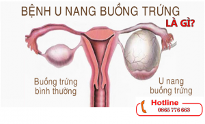 U nang buồng trứng