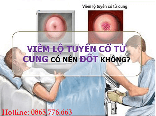 viêm lộ tuyến cổ tử cung có nên đốt hay không?